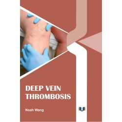 Deep Vein Thrombosis